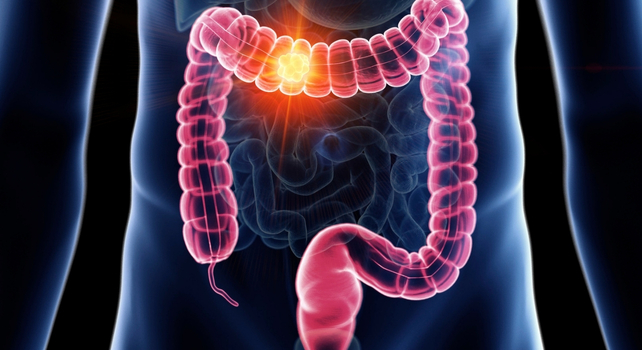 illustration of bowel cancer location