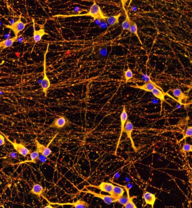 Depiction of yellow and purple cells within a reddish-brown fibrous matrix.