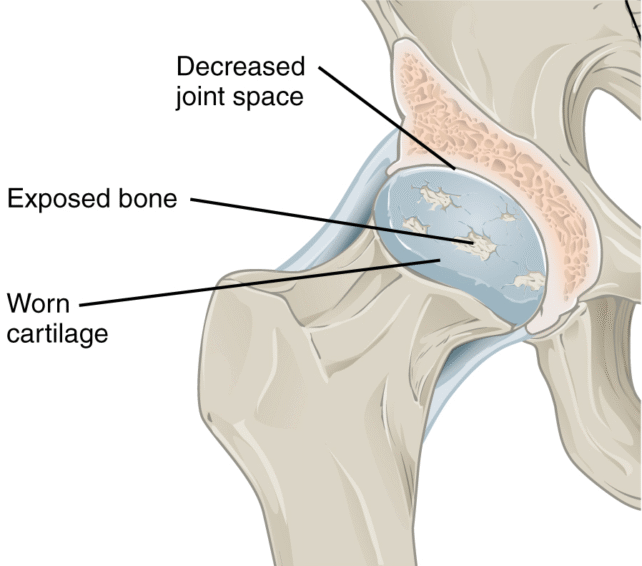 An illustration depicting the multifaceted tissue damage caused by osteoarthritis, leading to pain and restricted movement.