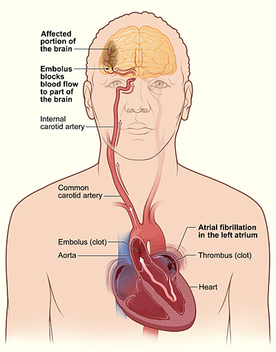 Illustration depicting the mechanism of stroke occurrence in atrial fibrillation. A thrombus may develop within the left atrium. If a fragment detaches and navigates to a cerebral artery, it can impede blood circulation. The resultant ischemia in the brain region supplied by that artery leads to a stroke.