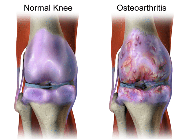 An illustrative depiction contrasting a healthy knee joint with one affected by osteoarthritis.