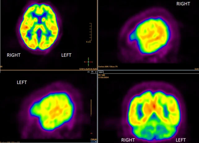 New Blood Test Can Predict Alzheimer's Progression Decades in Advance