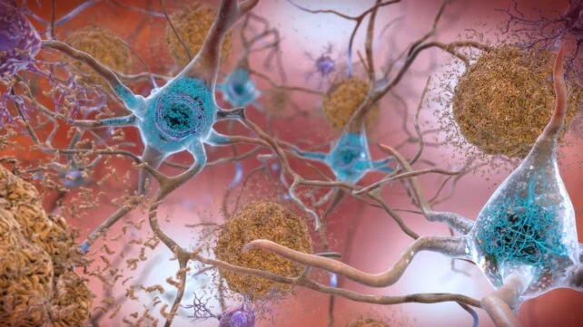 illustration of amyloid beta plaques in Alzheimer's disease