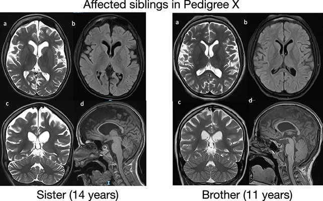 Illustration of brain structures