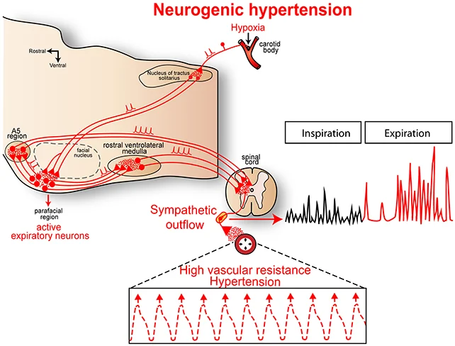 Hypertension diagram